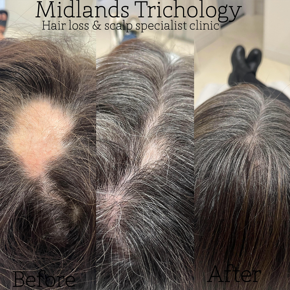 Midlands Trichology - Before and after photo