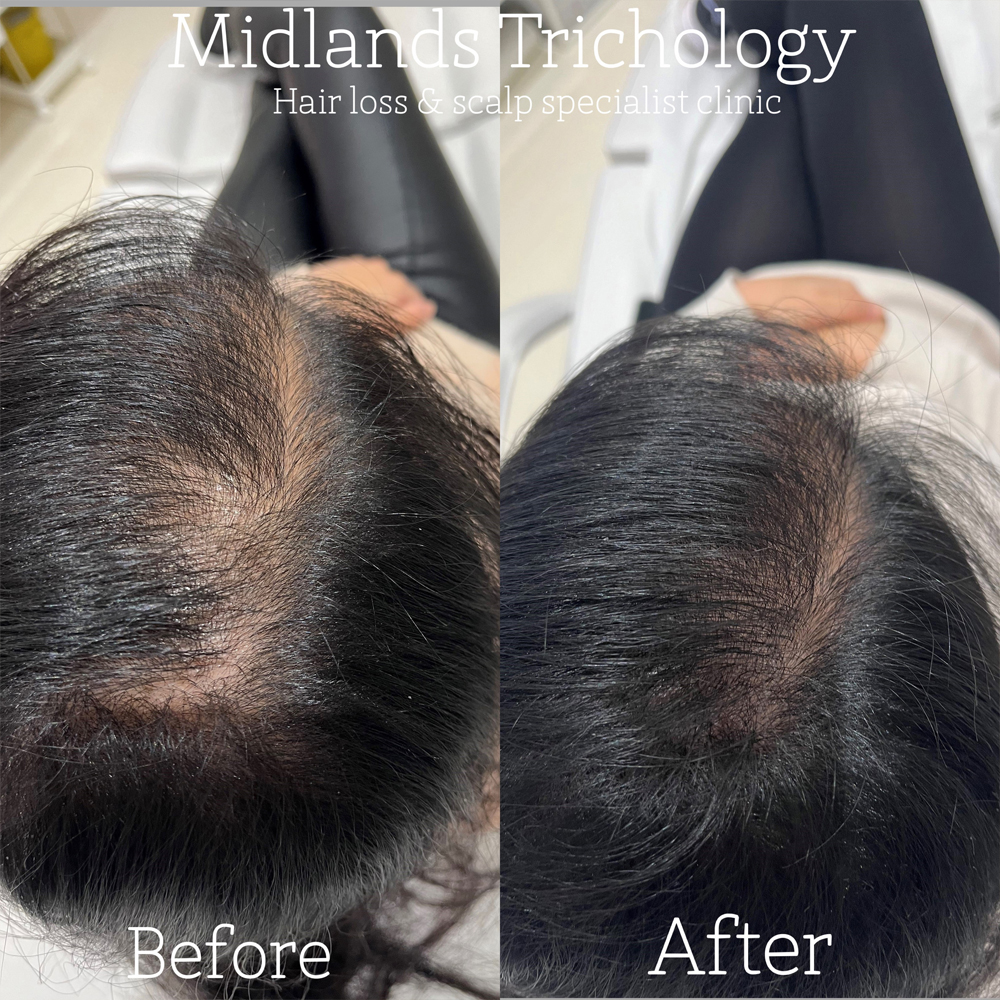 Midlands Trichology - Before and after photo