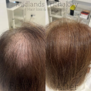 Midlands Trichology - Before and after photo