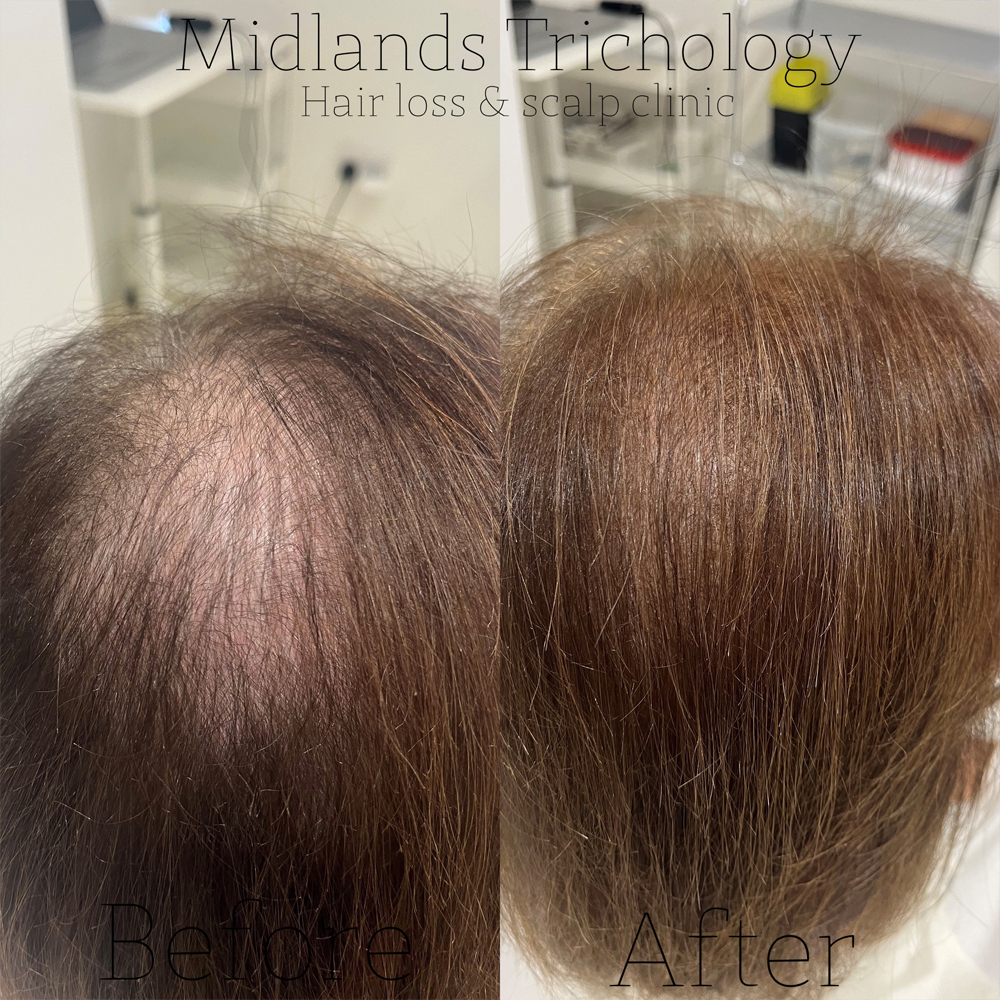 Midlands Trichology - Before and after photo