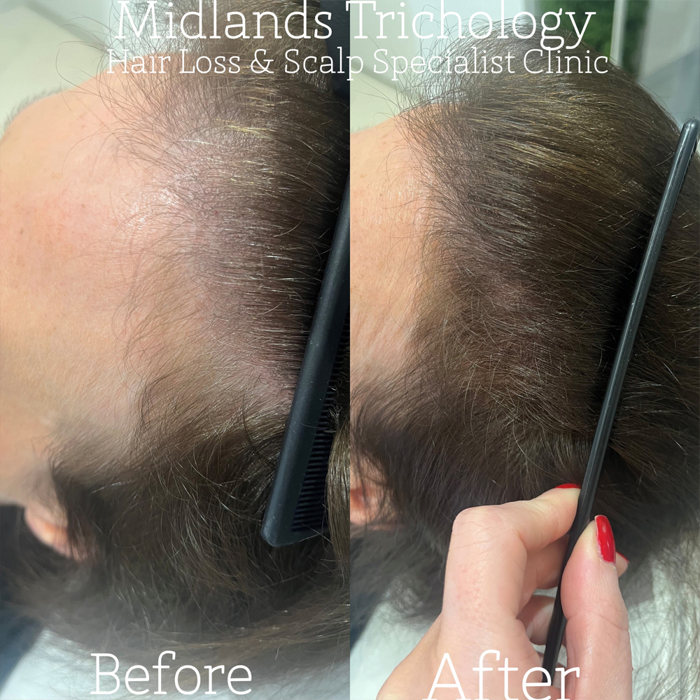 Midlands Trichology - Before and after photo