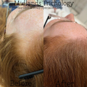 Midlands Trichology - Before and after photo