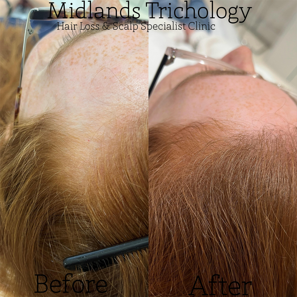 Midlands Trichology - Before and after photo