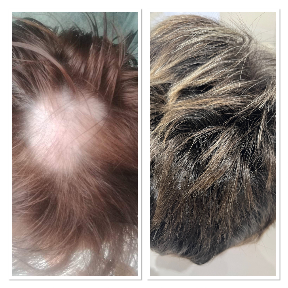 Midlands Trichology - Before and after photo