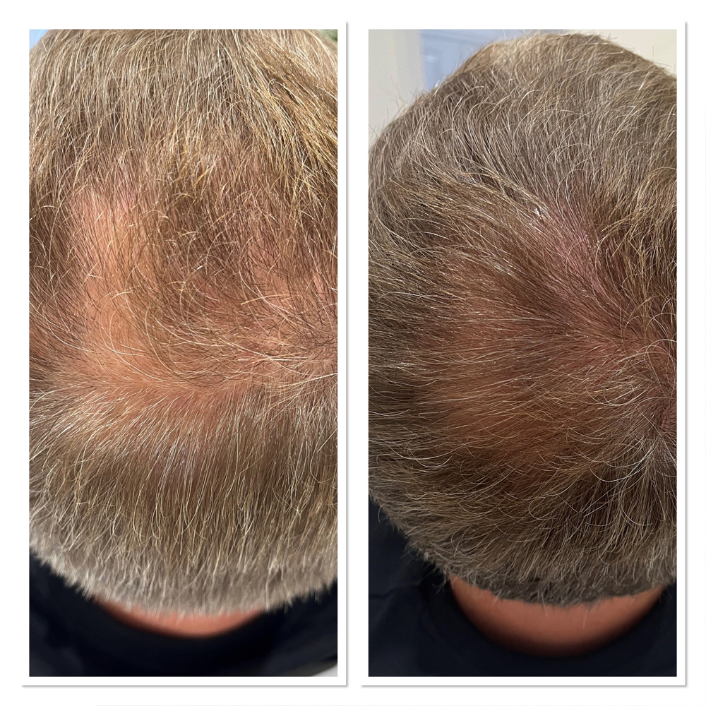 Midlands Trichology - Before and after photo
