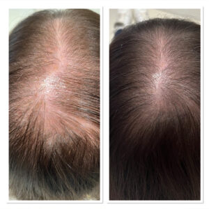 Midlands Trichology - Before and after photo