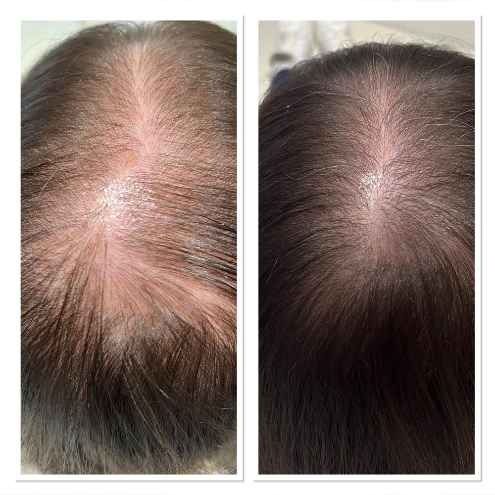 Midlands Trichology - Before and after photo