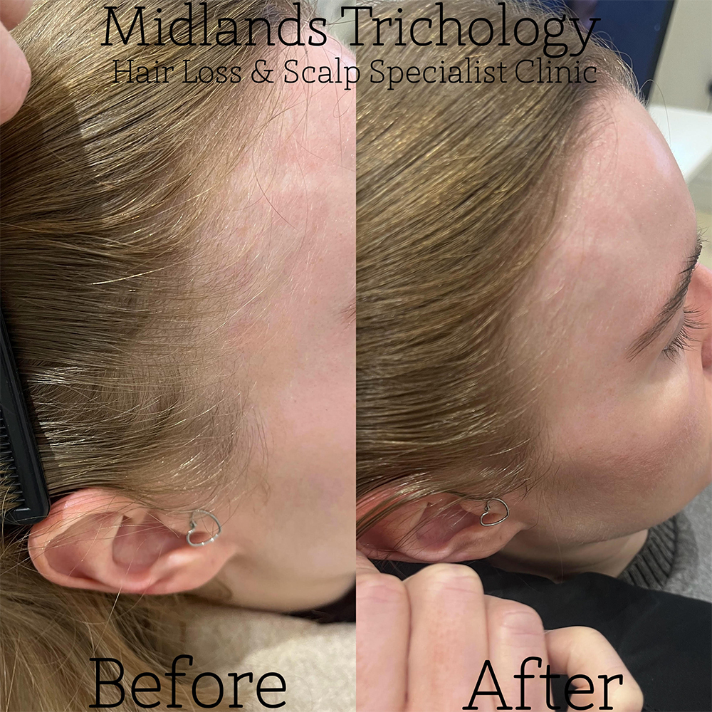 Midlands Trichology - Before and after photo